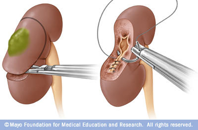 Laparoscopic Partial Nephrectomy